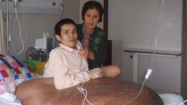 Before surgery: Nguyen Duy Hai with his 90-kilogram tumour.