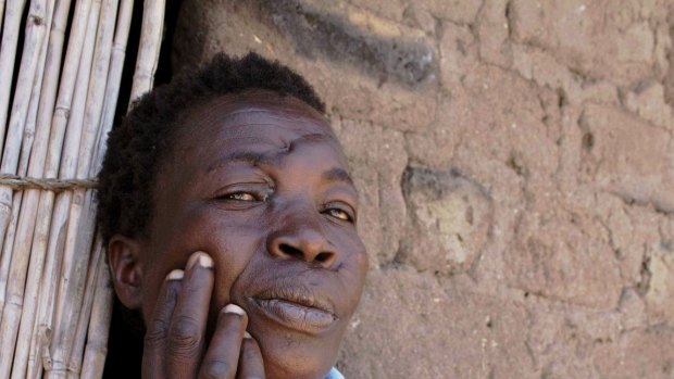 Mage Benge was attacked with machetes after she was accused of using witchcraft to kill her parents.  Tanzanian rights groups recorded 765 witchcraft related murders in 2013.