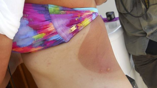 Chloe McCardel shows jellyfish stings: "It's like fireballs in every fibre."