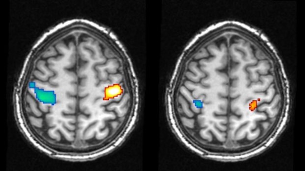 Brain scans showing activity in the motor cortex during the movement of the hands while awake (left) and during a dreamed movement (right). 