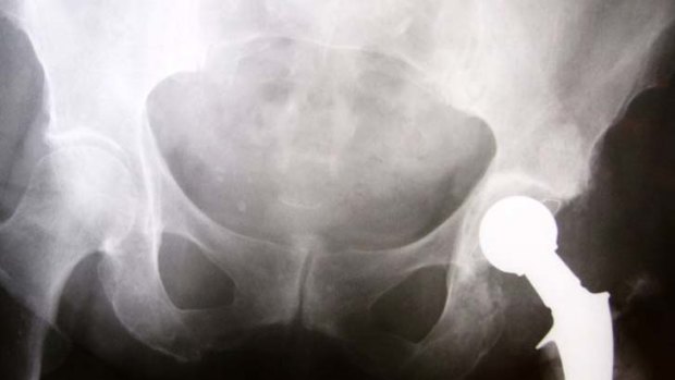 Painful ... 2700 hip prostheses were implanted last year, despite records showing 24 brands failing at twice the normal rate.