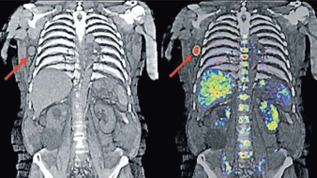 Accurate ... a PET scan showing the new internal melanoma tracer.