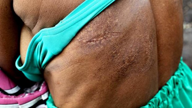 Janet Kemo Fogodi was victim of a brutal attack in which a family member tried to murder her due to "sorcery". Changes to PNG laws will prevent people who commit violent acts from using sorcery as a defence.