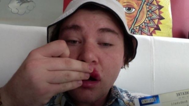 NOFX fan 'Alex' shows off his swollen lip on Twitter after allegedly being hit by NOFX lead singer 'Fat Mike' Burkett during the band's gig on November 5, 2014 in Sydney.