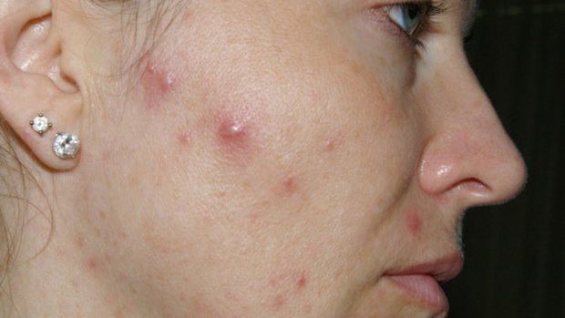 Wendy Reiner, before using her acne cream