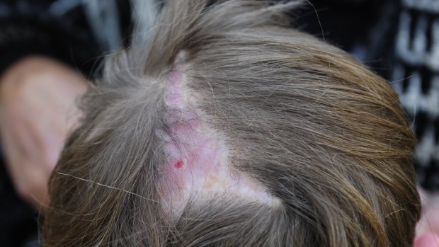 Dog attack victim Jack Hartigan shows the injuries to his scalp. 