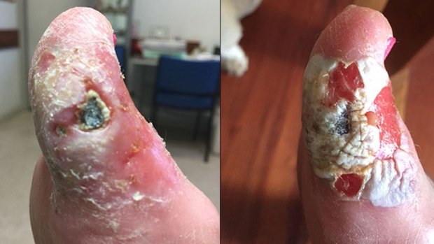a nail salon employee poured chemical metal steriliser over a woman's foot believing it would act as an antiseptic for a deep cut caused by a blade.