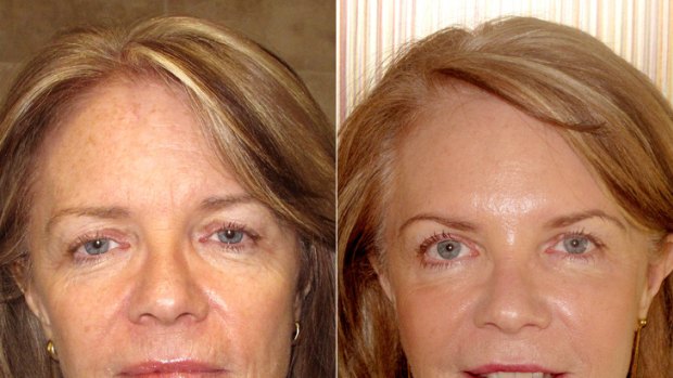 Mirror image ... Natalie Cheney before and after liquid facelift treatment.