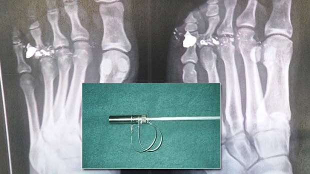 An x-ray of the man's injured foot, and [inset] the spear gun.