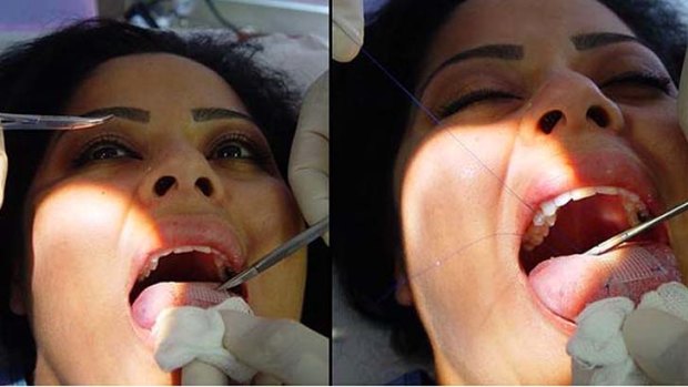 'Miracle' cure? The tongue patch procedure.