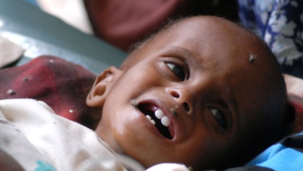 A severely malnourished child admitted to Banadir hospital in the Somali capital Mogadishu.