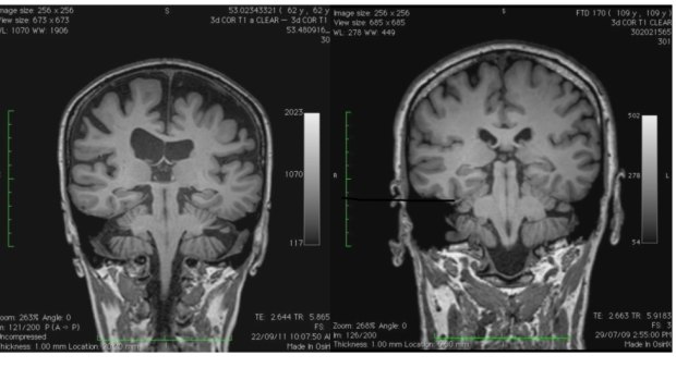 Christine Bryden's brain scan (left) shows significant atrophy compared to the image of a person without dementia (right).