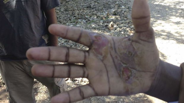 The hand of an asylum seeker, whom the Australian Navy allegedly abused.