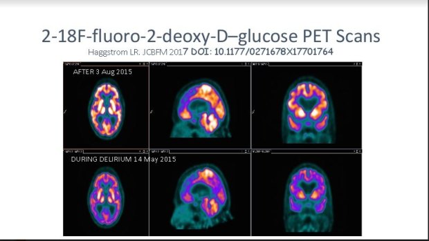 PET scans showing abnormal glucose metabolism in the brain of a patient with delirium.