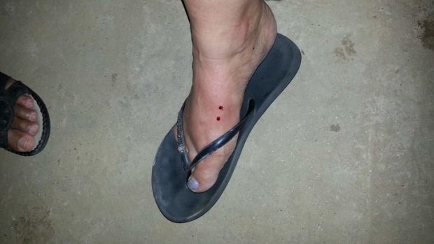 Delmae Ryan's foot after the snake bite.