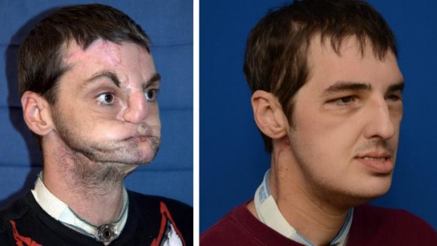 Richard Norris before and after the transplant surgery.