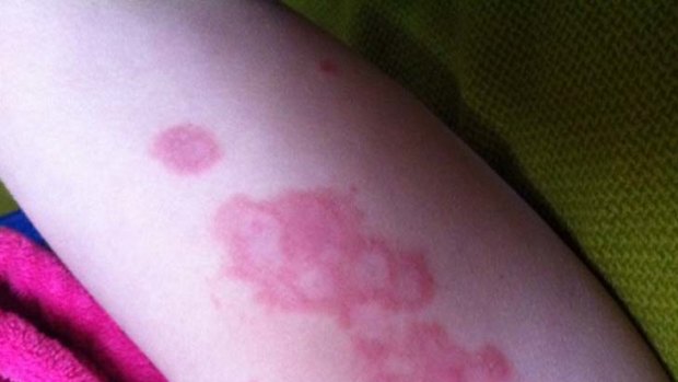 The Clean Ocean Foundation is launching a medical log to reigster health complaints linked to Melbourne beaches such as this girl's leg ulcers.