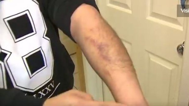The man's bruised forearm.