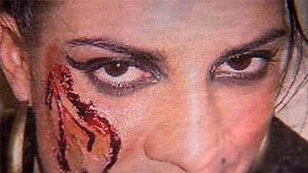 A photo of Eva Scolaro dressed up as a glassing victim provoked outrage.