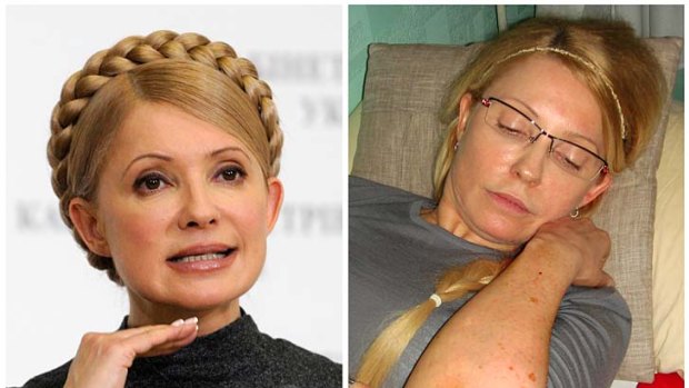 Ukrainian Prime Minister Yulia Tymoshenko shows bruises on her body to the Ukrainian Commissioner for Human Rights.