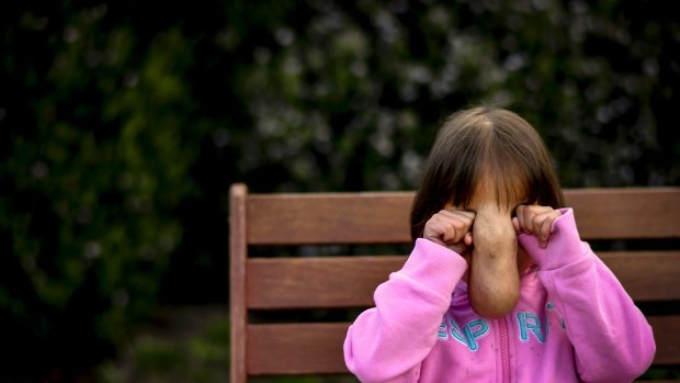 Precy, a four-year-old girl from the Phillipines. She had an encephalocele, a protrusion where cranial contents gather when bones in the skull haven't formed.