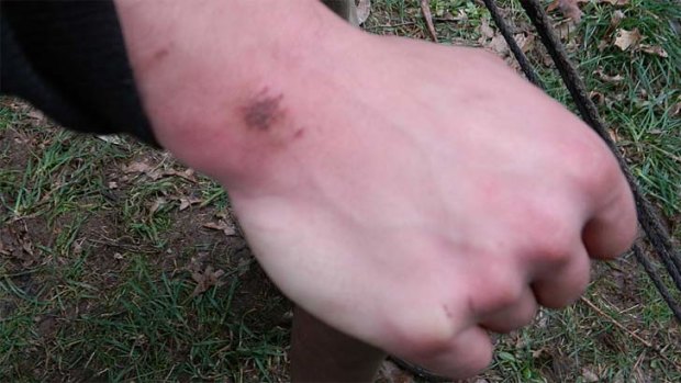 One of the protester's wrists after the attack.