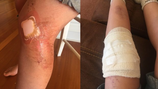 Festival-goer Olivia Jones' injured leg as a result of Friday night's crush.