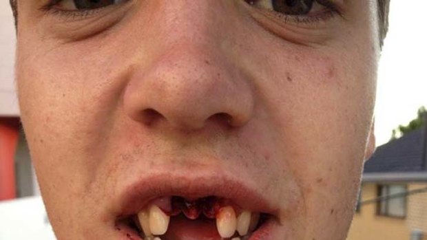 Hard knock: Gold Coast's Seb Tape had his two front teeth knocked out.