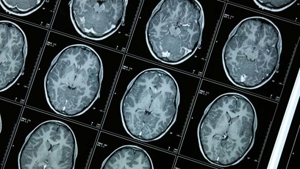 Hopes for early identification: About 1700 new cases of dementia are estimated to be diagnosed in Australia each week.