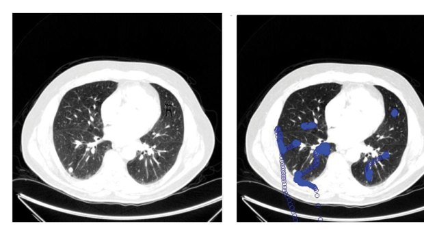 The gorilla image is in the top right of the CT scan. Eye-tracking software (right) indicated that more than half the doctors looked directly at it.