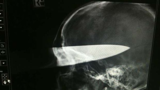 An X-ray of Alex's skull.