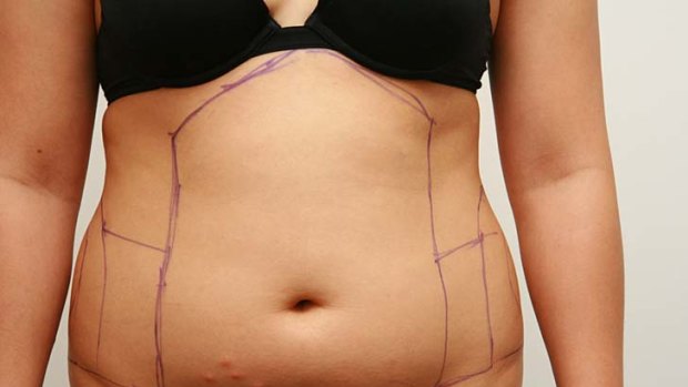The fat comes back ... Surprising results from liposuction study.