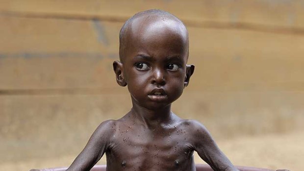 One who is getting help ... Aden Salaad, 2, at a Doctors Without Borders hospital in Kenya, where he is being treated for malnutrition.