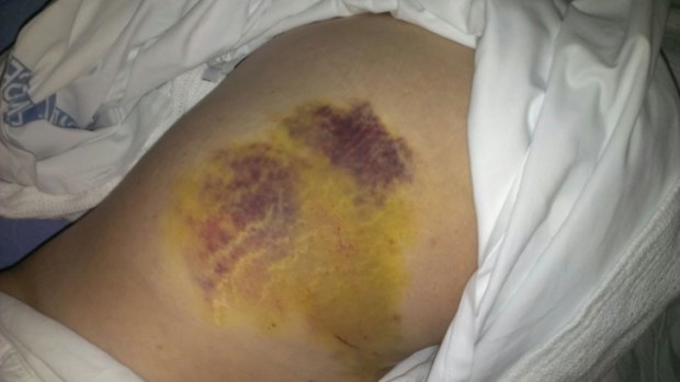Bruising on Joan Dartnell's back sustained in the crash.
