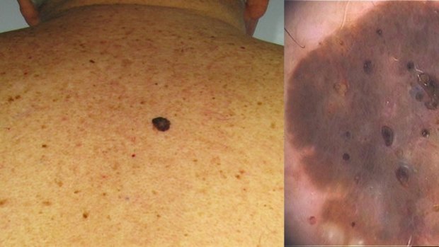 Common lumps and bumps on and under the skin: what are they?