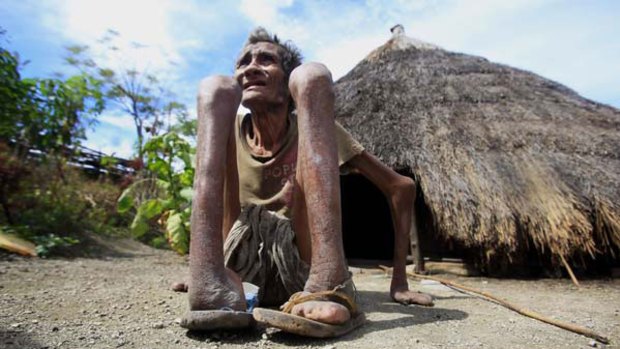 Leprosy victim Adelino Quelo outside his hut.