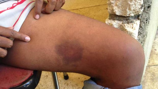 An African asylum seeker with bruises he says were inflicted by the Australian Navy