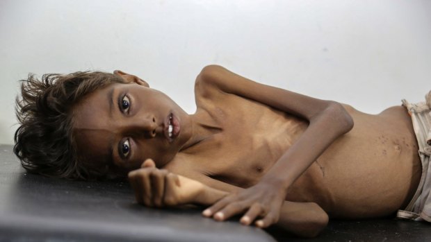 Five-year-old Mohannad Ali lies on a hospital bed in Abs, Yemen, in December. His two-year-old cousin died of hunger.