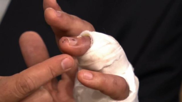 Jimmy Fallon reveals nearly losing a finger in ring avulsion injury