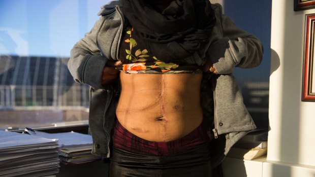 Rajvir Kaur's scars are from a liver transplant and bowel surgery that she had to have after eating the mushrooms.