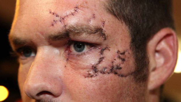 Permanent damage ... Chris Deacon needed 120 stitches after he was attacked with a glass at a hotel.