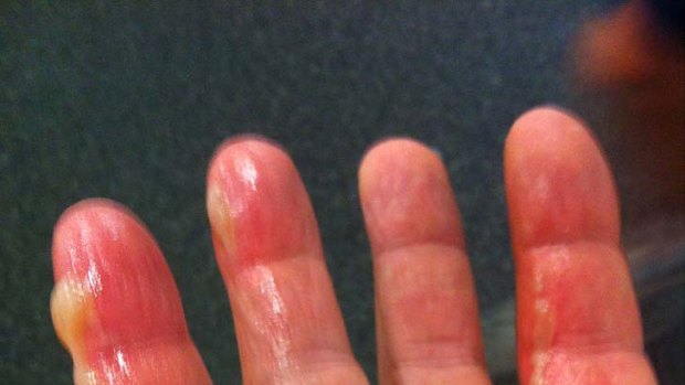 Ham fisted ... Warne's famous hand bowling hand was burnt while frying bacon.