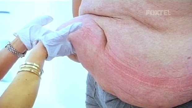 Malcolm has lost 90 kilograms but he's been left with a truckload of smelly excess skin.