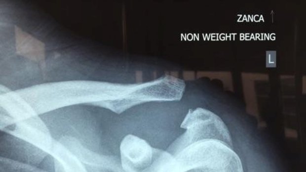 Gap: The X-ray which shows the separation in Farah’s shoulder.