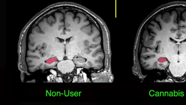MRI scans illustrating the damage long-term cannabis use can cause.