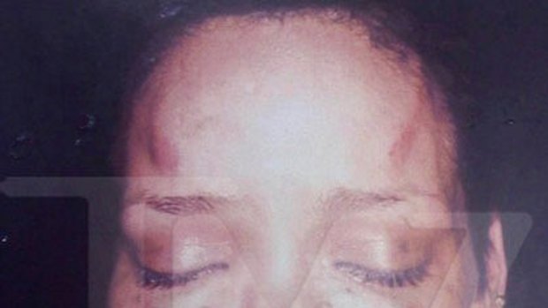 An image taken from TMZ shows injuries sustained by Rihanna after being assaulted by then-boyfriend Chris Brown.