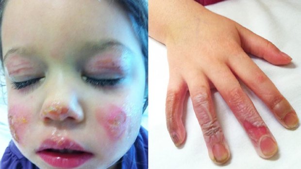 Scarred ... Ava Lyons suffered severe burns to her hand and face after a portable DVD player caught fire while she was travelling in the family car.