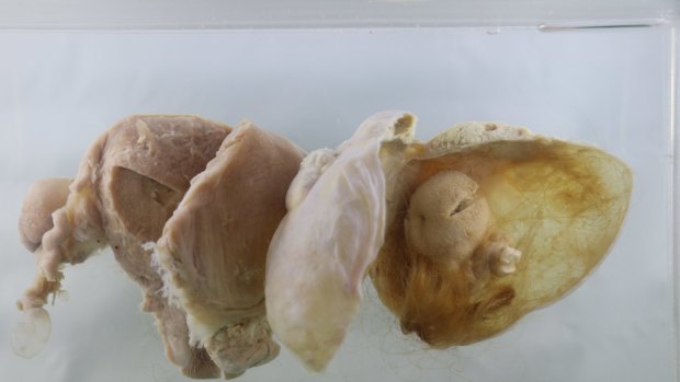 Teratoma specimen from the Museum of Human Disease. For Spectrum objects story.