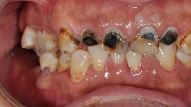 One of Dr David Digges pro bono patients arrived with teeth ruined by years of hard life, neglect and diffculty accessing dental care. 