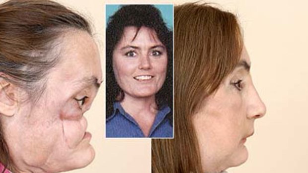 Connie Culp after the shotgun blast (left), how she was before, and how she looks after the operation.